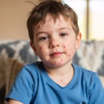 O que é catapora: sinais de alerta, contágio e mitos